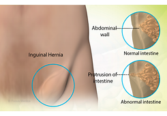 Hernia