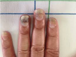 What Causes Green Nails?