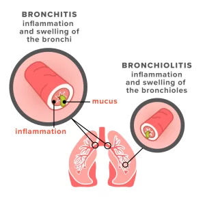 What is Bronchitis