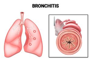 What is Bronchitis?
